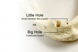 mini-implant-hole